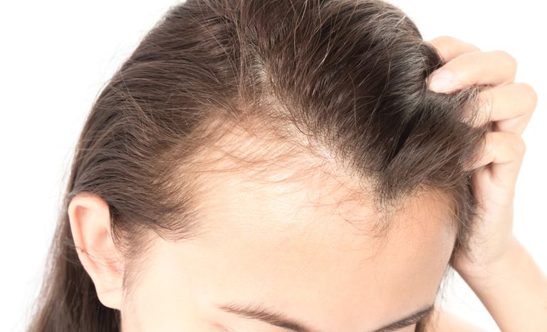 How mold allergies cause hair loss