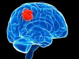 Tips for managing ‘brain tumor’ patients