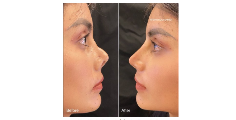 Dr. Simon Ourian’s Revolutionary Non-Surgical Nose Job Technique