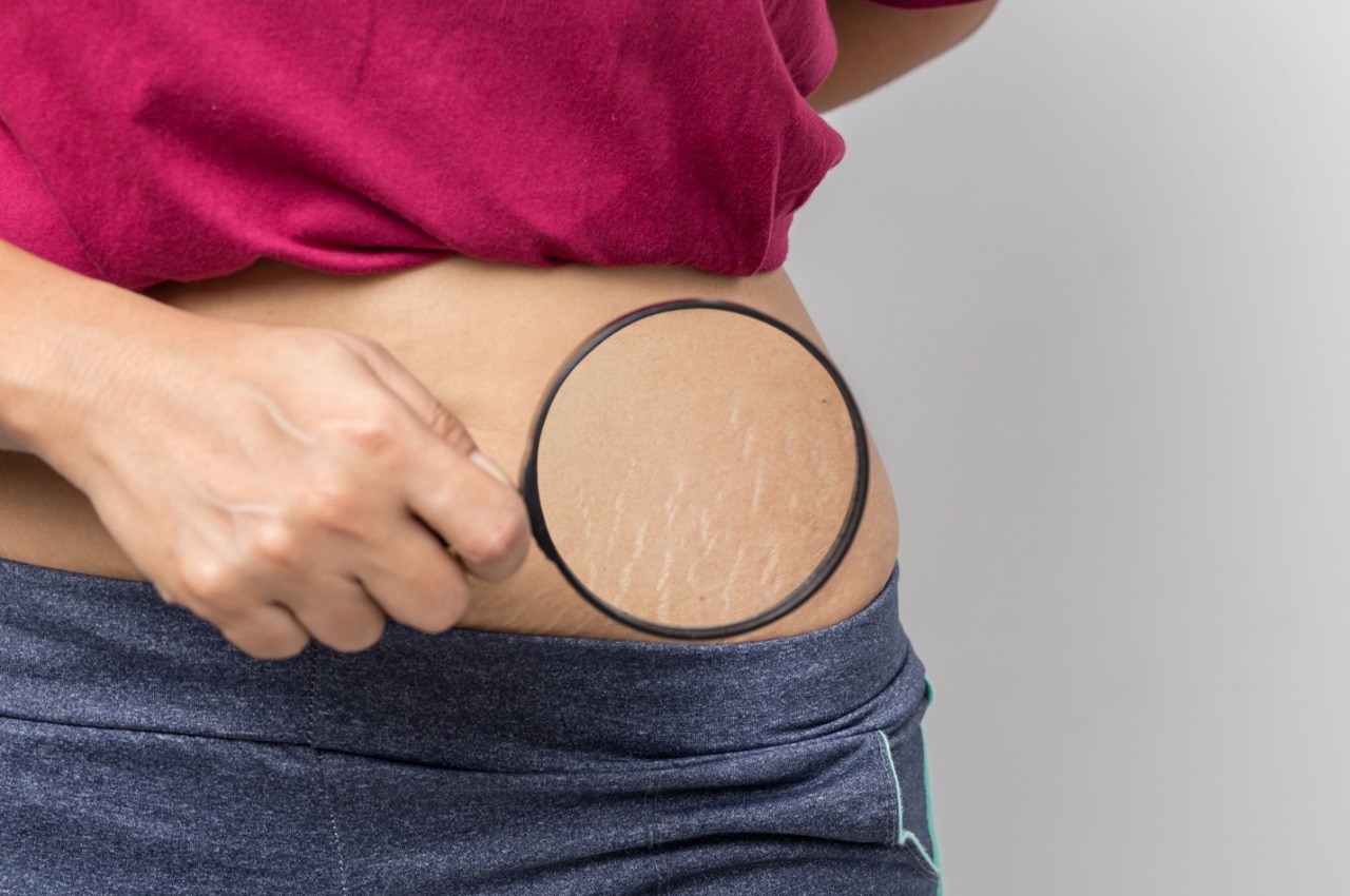 Dr. Simon Ourian’s Guide to Celebrity Favorite Coolbeam Stretch Mark Removal