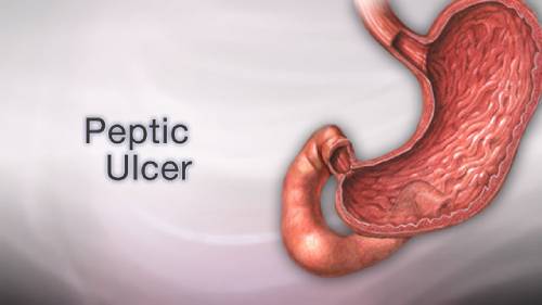 Causes And Remedies For Stomach Ulcers